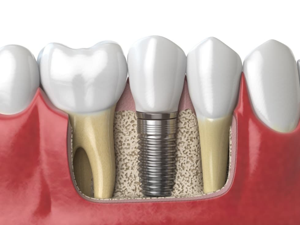 Процедура имплантации зубов в стоматологической клинике 